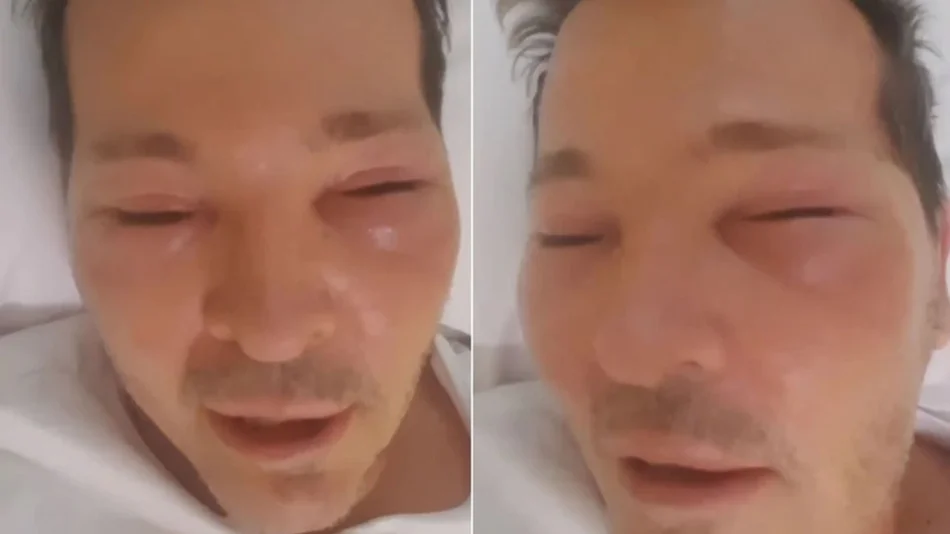 VÍDEO: Preocupa la salud de Guido Süller, está internado con la cara desfigurada