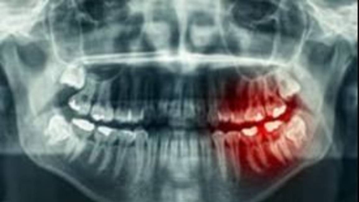 Cáncer de boca: cuáles son los síntomas, las causas y el tratamiento 