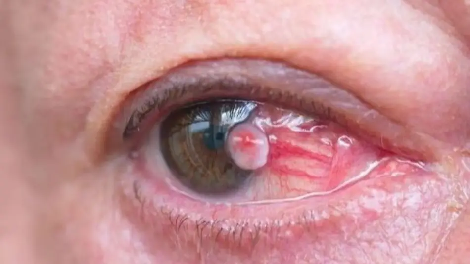 Cáncer de ojo: estos son los síntomas para detectar rápido la enfermedad