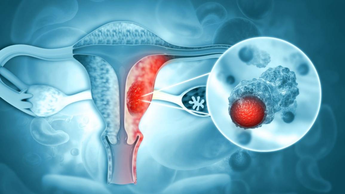 Presentaron en la Argentina un nuevo tratamiento para pacientes con cáncer de endometrio avanzado